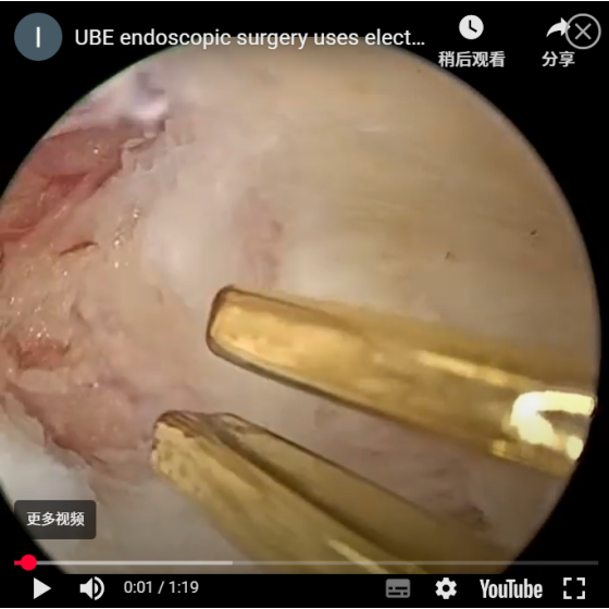 The use of bipolar electrocoagulation forceps in UBE endoscopic surgery
